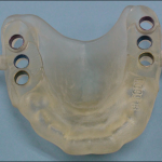 Custom surgical template for dental implants